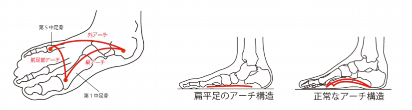 扁平足のアーチ構造、正常なアーチ構造